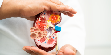 Glomerulonephritis : Types, Causes, Symptoms, Diagnosis and Treatment 6 Glomerulonephritis : Types, Causes, Symptoms, Diagnosis and Treatment