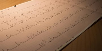 Myocardial Infarction: Causes, Symptoms, Diagnosis, Treatment, and Prognosis