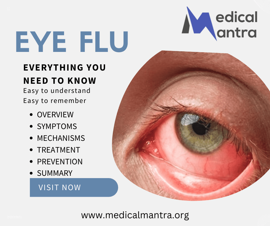 Eye Flu: Causes, Symptoms, Treatment, Prevention, and Medical Mechanism 14 Eye Flu: Causes, Symptoms, Treatment, Prevention, and Medical Mechanism